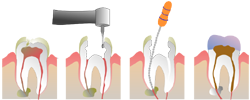Fases de endodontia